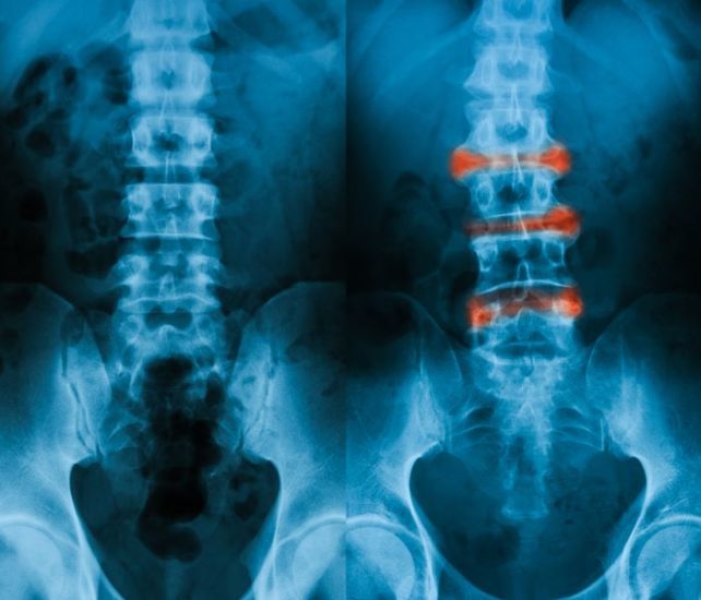 Early Warning Signs of Ankylosing Spondylitis - Comparisonsmaster