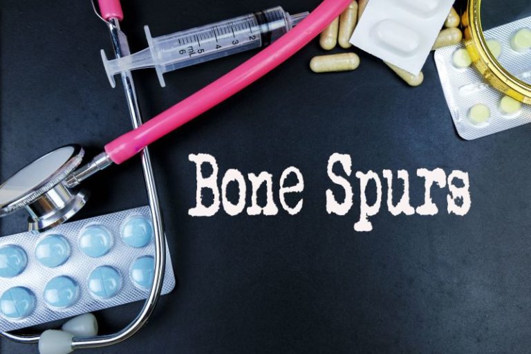 Bone Spur Early Symptoms and Treatment Options Comparisonsmaster